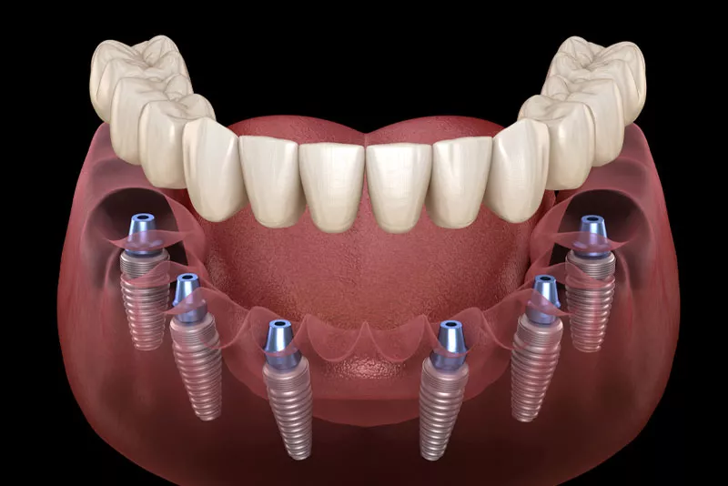 Tooth Replacement